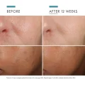 SkinCeuticals Phloretin CF Antioxidant Serum with Vitamin C and Ferulic Acid 5